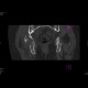 Acetabular fracture, posterior dislocation of the femoral head, dashboad injury: CT - Computed tomography