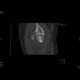 Acetabular fracture, posterior dislocation of the femoral head, dashboad injury: CT - Computed tomography