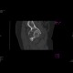 Acetabular fracture, posterior dislocation of the femoral head, dashboad injury: CT - Computed tomography