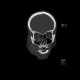 Teardrop figure, orbital floor fracture, blow-out fracture: CT - Computed tomography