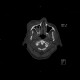 Teardrop figure, orbital floor fracture, blow-out fracture: CT - Computed tomography