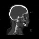 Teardrop figure, orbital floor fracture, blow-out fracture: CT - Computed tomography