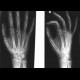 Fracture of the navicular bone: X-ray - Plain radiograph