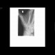 Fracture of the navicular bone: X-ray - Plain radiograph