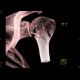 Fracture of humerus, comminuted: CT - Computed tomography