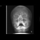 Fracture of the mandible: X-ray - Plain radiograph