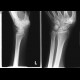 Fracture of navicular bone, rhizarthrosis: X-ray - Plain radiograph