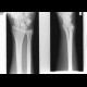 Fracture of navicular bone: X-ray - Plain radiograph