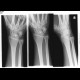 Fracture of navicular bone: X-ray - Plain radiograph