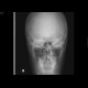 Fracture of orbital floor, teardrop sign, blowout fracture, hemosinus: X-ray - Plain radiograph