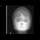 Fracture of orbital floor, teardrop sign, blowout fracture, hemosinus: X-ray - Plain radiograph