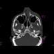 Fracture of orbital floor, teardrop sign, blowout fracture, hemosinus: CT - Computed tomography