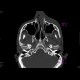 Fracture of orbital floor, teardrop sign, blowout fracture, hemosinus: CT - Computed tomography