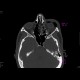 Fracture of orbital floor, teardrop sign, blowout fracture, hemosinus: CT - Computed tomography