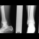 Epiphyseal fracture of the posterior edge of tibia, Salter Harris II: X-ray - Plain radiograph