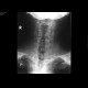 Fracture of dens axis: X-ray - Plain radiograph