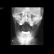 Fracture of dens axis: X-ray - Plain radiograph