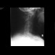 Fracture of dens axis: X-ray - Plain radiograph
