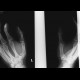 Fracture of navicular bone, fracture of first metacarpal bone: X-ray - Plain radiograph