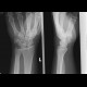 Fracture of navicular bone, fracture of first metacarpal bone: X-ray - Plain radiograph