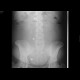 Gravidity: X-ray - Plain radiograph