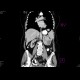 Renal cell carcinoma: CT - Computed tomography