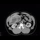 Hemangioma: CT - Computed tomography