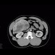 Liver hemangioma, gigantic: CT - Computed tomography
