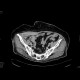 Small hematoma in the right groin, after angiography: CT - Computed tomography