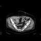 Small hematoma in the right groin, after angiography: CT - Computed tomography