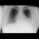 Diaphraghmatic hernia, herniation of lienal flexure and stomach: X-ray - Plain radiograph