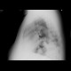 Diaphraghmatic hernia, herniation of lienal flexure and stomach: X-ray - Plain radiograph