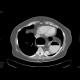 Diaphraghmatic hernia, Bochdalek hernia: CT - Computed tomography