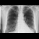 Large hiatal hernia on chest radiograph: X-ray - Plain radiograph