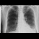 Large hiatal hernia on chest radiograph: X-ray - Plain radiograph