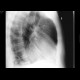 Large hiatal hernia on chest radiograph: X-ray - Plain radiograph