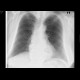 Hiatal hernia, chest radiograph: X-ray - Plain radiograph