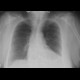 Hiatal hernia, chest radiograph: X-ray - Plain radiograph