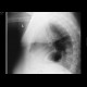 Hiatal hernia, chest radiograph: X-ray - Plain radiograph