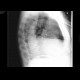Hydrothorax, pleural effusion: X-ray - Plain radiograph