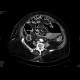 Ileus, pneumoperitoneum, peritonitis: CT - Computed tomography