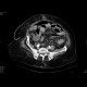 Ileus, pneumoperitoneum, peritonitis: CT - Computed tomography