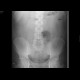 Ileus, small bowel obstruction: X-ray - Plain radiograph