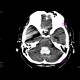 Intracerebral hemorhage, hemocephalus, tamponaded fourth ventricle: CT - Computed tomography