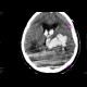 Intracerebral hemorhage, hemocephalus, tamponaded fourth ventricle: CT - Computed tomography