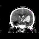 Intracerebral hemorhage, hemocephalus, tamponaded fourth ventricle: CT - Computed tomography
