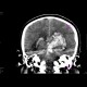 Intracerebral hemorhage, hemocephalus, tamponaded fourth ventricle: CT - Computed tomography