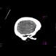 Intracerebral hemorhage, artifact from malfunctioning detector: CT - Computed tomography