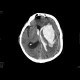 Intracerebral hemorhage, artifact from malfunctioning detector: CT - Computed tomography