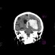 Intracerebral hemorhage, hemocephalus, artifact from malfunctioning detector: CT - Computed tomography